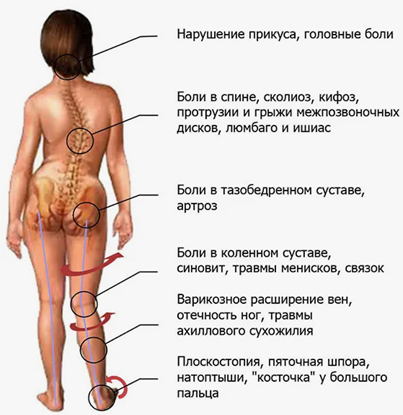 Сколиоз - что это, степени, причины, лечение