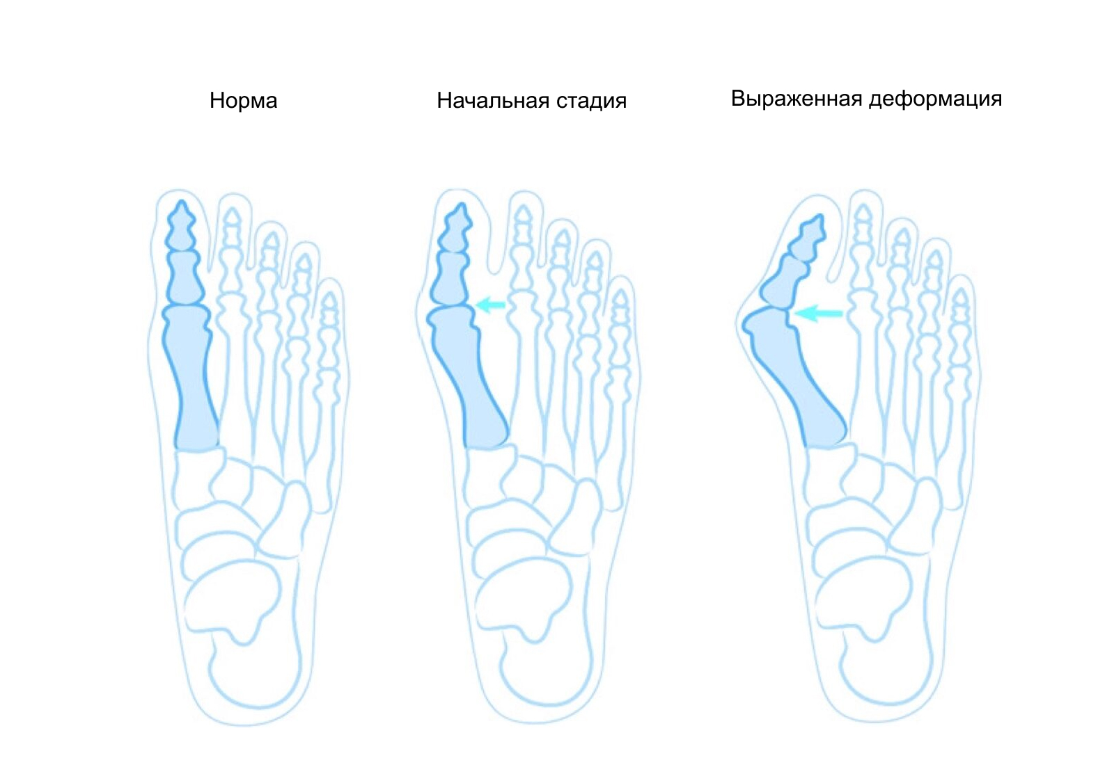 стельки при плоскостопии степени